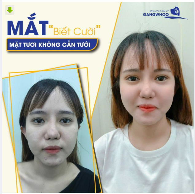 TẠO MẮT HAI MÍ - MẮT BIẾT CƯỜI, MẶT TƯƠI KHÔNG CẦN TƯỚI