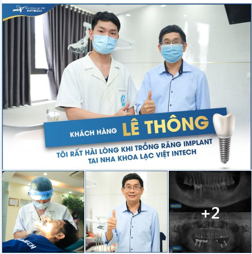 TAY NGHỀ BÁC SĨ QUYẾT ĐỊNH THÀNH CÔNG CỦA CA TRỒNG RĂNG IMPLANT