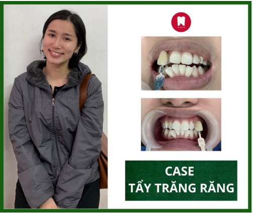 TẨY TRẮNG RĂNG BẰNG PHƯƠNG PHÁP NÀO TỐT