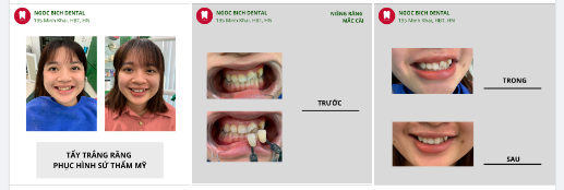 TẨY TRẮNG RĂNG - PHỤC HÌNH SỨ THẨM MỸ