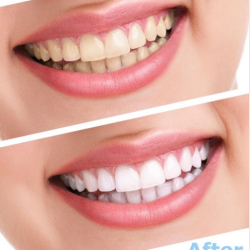 Tẩy trắng răng tại nhà hay tại nha khoa thì hiệu quả hơn