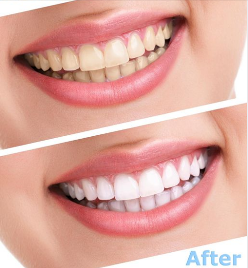Tẩy trắng răng tại nhà hay tại nha khoa thì hiệu quả hơn