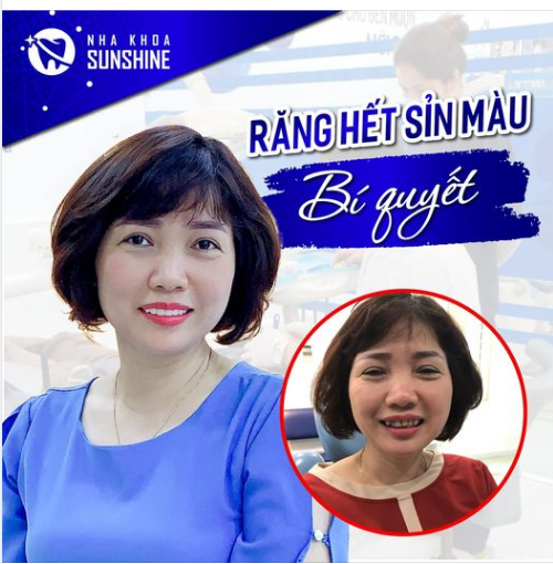 TẨY TRẮNG RĂNG WHITEMAX  GIẢI PHÁP NHANH NHẤT CHO NỤ CƯỜI