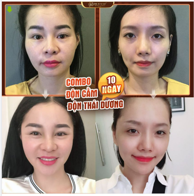Thái dương HÓP Cằm ngắn, lẹm Khiến gương mặt bạn trở nên già trước tuổi, thiếu cân đối.