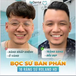 Thẩm mỹ 16 răng sứ Đức - Anh Lâm - khách hàng của Be đã thay đổi diện mạo trẻ trung khác lạ