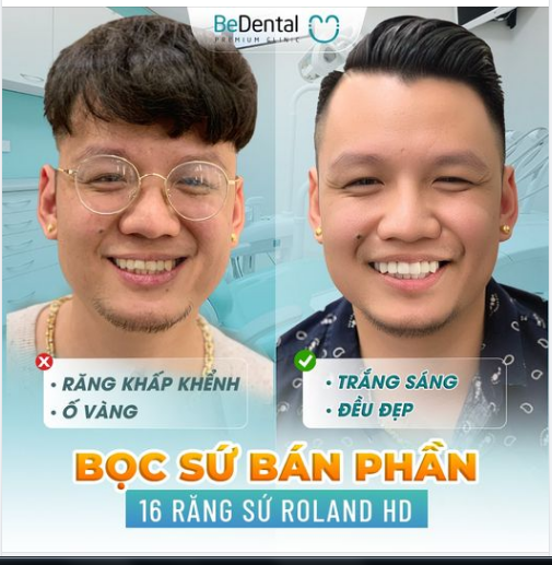 Thẩm mỹ 16 răng sứ Đức - Anh Lâm - khách hàng của Be đã thay đổi diện mạo trẻ trung khác lạ