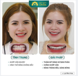Thẩm mỹ răng sứ - chữa khớp cắn ngược và làm đẹp cho răng xinh