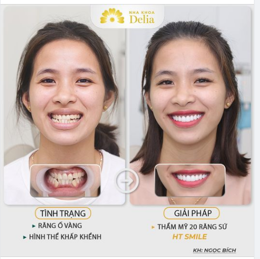 THẦN THÁI x10 NHỜ THẨM MỸ RĂNG SỨ