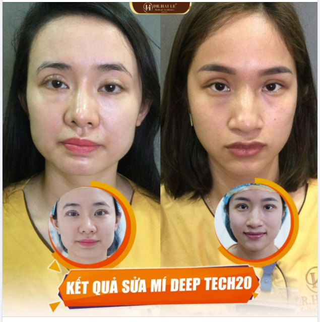 THANH XUÂN " ĐẸP LẠI" CHỈ SAU KHI SỬA MÍ DEEP TECH20