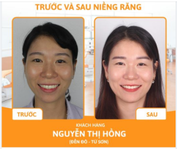 THÁO NIỀNG CHO KHÁCH HÀNG NIỀNG RĂNG HÔ - KHẤP KHỂNH