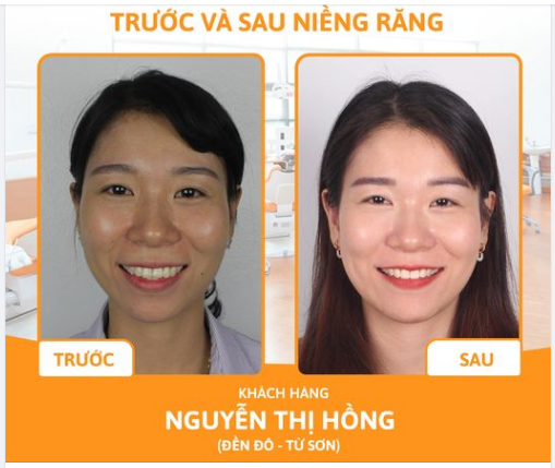 THÁO NIỀNG CHO KHÁCH HÀNG NIỀNG RĂNG HÔ - KHẤP KHỂNH