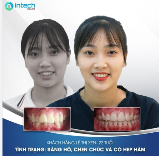 THÁO NIỀNG SAU HƠN 2 NĂM NIỀNG RĂNG HÔ, CHEN CHÚC CÓ HẸP HÀM