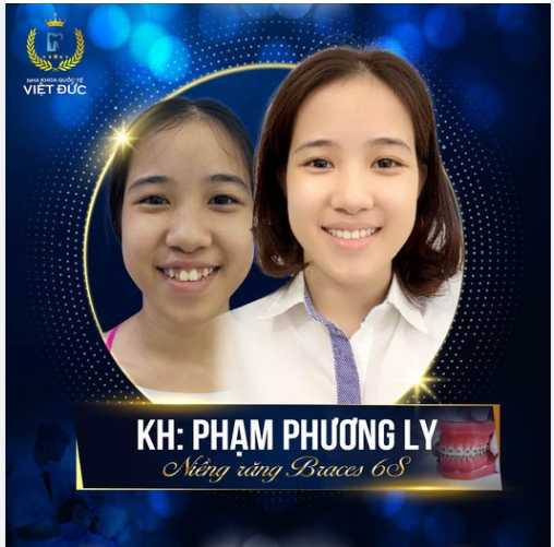 Tháo Niềng Xinh Như Hotgirl- Biết Thế Niềng Sớm Hơn