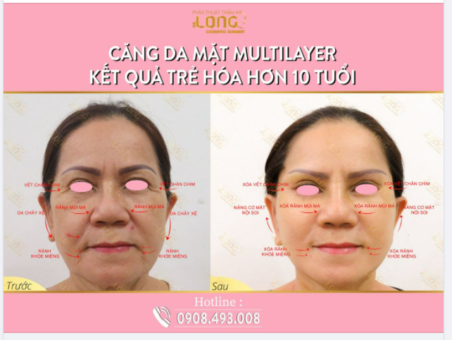 THAY ÁO MỚI CHO LÀN DA CHƯA BAO GIỜ LÀ QUÁ MUỘN