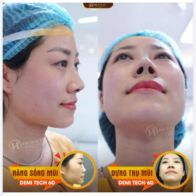Thay dáng mũi - Đổi vận may!!
