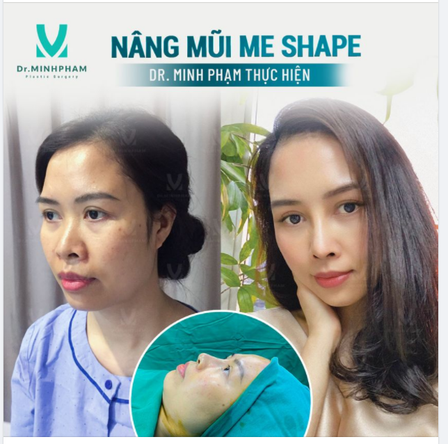 THAY ĐỔI BẤT NGỜ VỚI MŨI ME SHAPE KỸ THUẬT NÂNG MŨI AN TOÀN HIỆN ĐẠI .