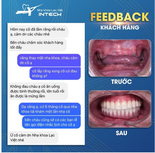 THAY ĐỔI DIỆN MẠO HOÀN HẢO VỚI TRỒNG RĂNG IMPLANT TOÀN HAI HÀM