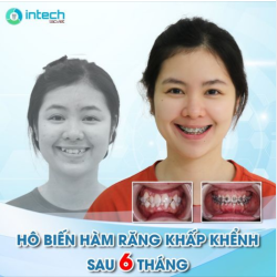 THAY ĐỔI NGOẠN MỤC HÀM RĂNG KHẤP KHỂNH SAU 6 THÁNG NIỀNG RĂNG