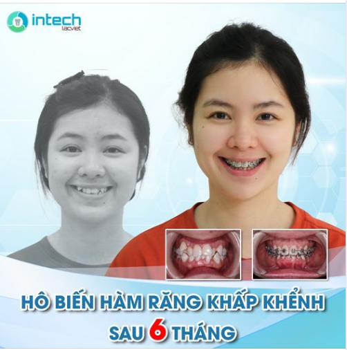 THAY ĐỔI NGOẠN MỤC HÀM RĂNG KHẤP KHỂNH SAU 6 THÁNG NIỀNG RĂNG