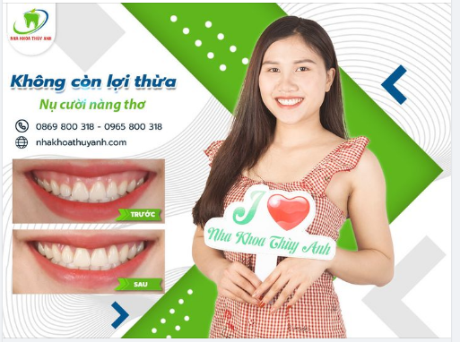 THAY ĐỔI NHỎ - KHÁC BIỆT LỚN SAU PHẪU THUẬT CƯỜI HỞ LỢI
