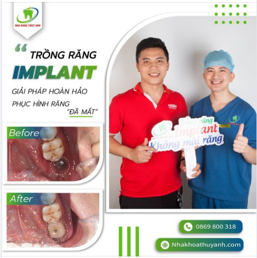THAY THẾ RĂNG MẤT BẰNG PHƯƠNG PHÁP CẤY GHÉP IMPLANT