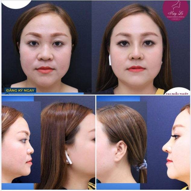 Thêm một em mũi Cấu trúc về đội của Hiệp Lợi