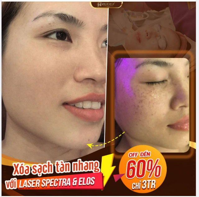 Thêm một minh chứng tuyệt vời cho chất lượng của CN điều trị tàn nhang LASER SPECTRA-ELOS tại Dr.Hải Lê.!!