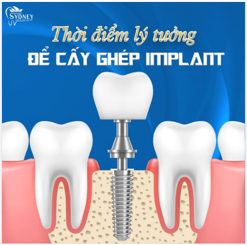 THỜI ĐIỂM LÝ TƯỞNG ĐỂ CẤY GHÉP IMPLANT