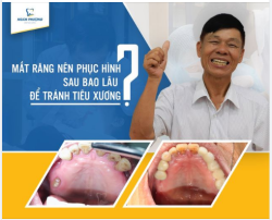 THỜI ĐIỂM VÀNG ĐỂ TRỒNG RĂNG IMPLANT TRÁNH CÁC BIẾN CHỨNG