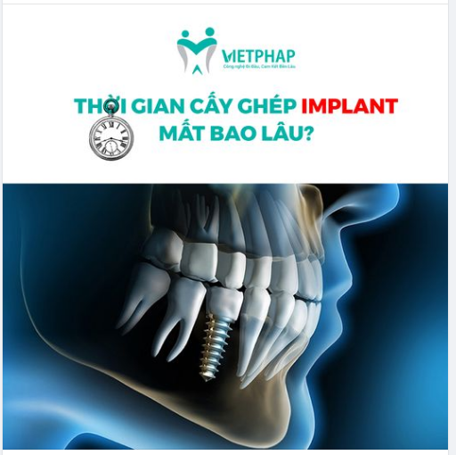 THỜI GIAN CẤY GHÉP IMPLANT MẤT BAO LÂU?