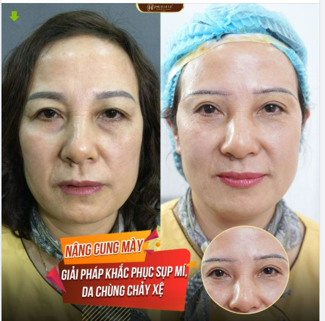 Thời gian, tuổi tác, lão hóa "kẻ thù" của phái đẹp Theo thời gian: Mắt sụp mí Da chùng chảy xệ Mắt già nua, u buồn