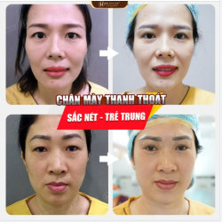 Thời gian, tuổi tác, lão hóa khiến vùng da mí xuất hiện mỡ thừa, da chùng, sụp mí...đôi mắt trở nên già nua, u buồn.