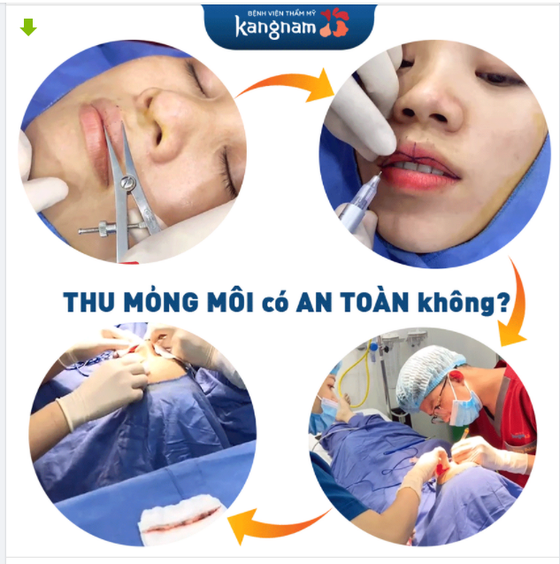 Thu mỏng môi có an toàn không?