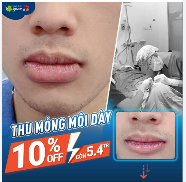 THU MỎNG MÔI - Thoát kiếp môi Dày/Trề