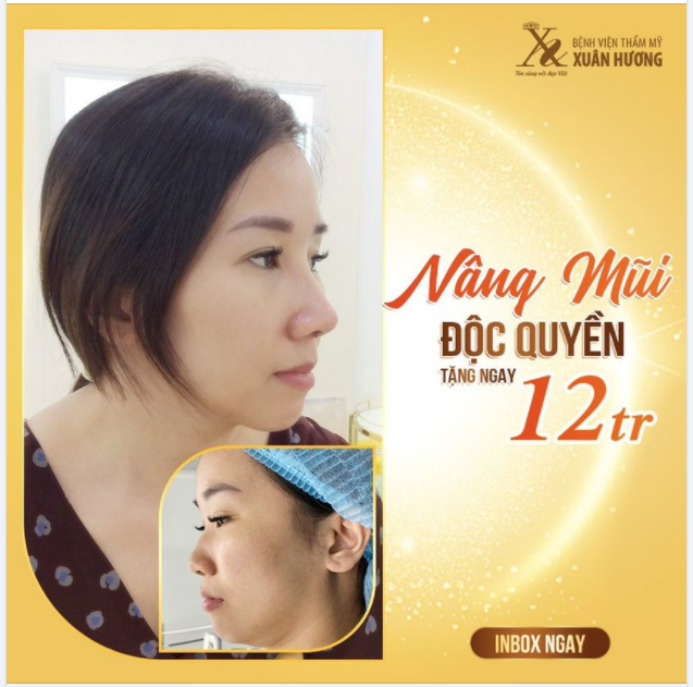 THỪA ĐỘ SANG, DƯ ĐỘ SÁNG CHỈ CẦN NÂNG MŨI