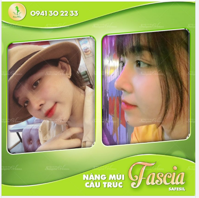 THÚY AN CHIA SẺ VÌ SAO NÊN CHỌN NÂNG MŨI TẠI TMV SAIGON VENUS