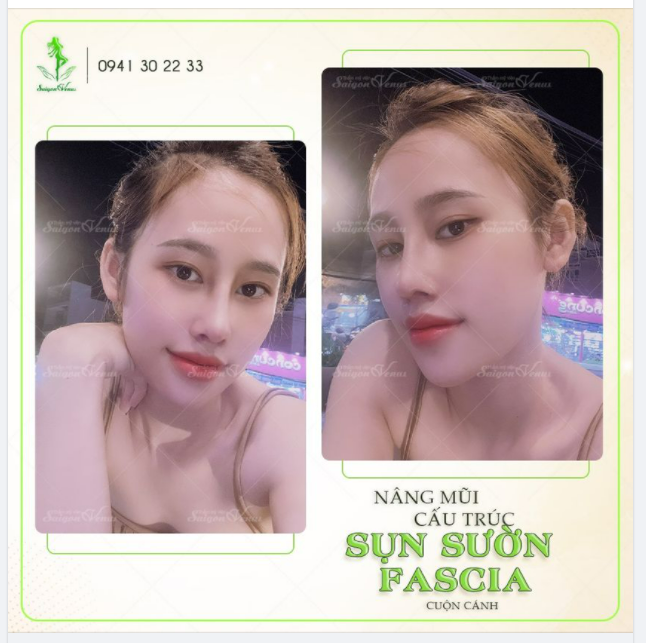 THÙY PHẠM THAY ĐỔI HOÀN TOÀN VỚI NÂNG MŨI SỤN SƯỜN FASCIA