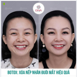 TIÊM BOTOX XÓA NẾP NHĂN ĐUÔI MẮT - TRẺ HÓA GƯƠNG MẶT
