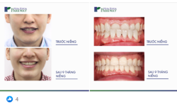 TIẾN TRÌNH NIỀNG RĂNG INVISALIGN: TẠM BIỆT RĂNG CẮN NGƯỢC CHỈ SAU 9 THÁNG