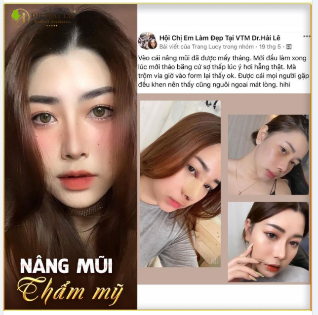 "Tiếp tục Feedback siêu xinh kết quả Nâng mũi của cô nàng Trang Lucy sau 1 tháng thực hiện đây ạ