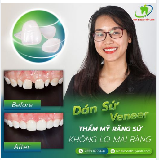 TIÊU CHUẨN ĐÁNH GIÁ MẶT DÁN SỨ CHẤT LƯỢNG
