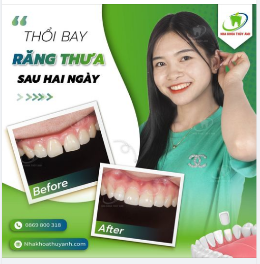 TIÊU CHUẨN ĐÁNH GIÁ MẶT DÁN SỨ CHẤT LƯỢNG