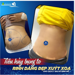 TIÊU HỦY BỤNG TO - RINH DÁNG ĐẸP XUÝT XOA CHO CHỊ K.T SAU KÌ SINH NỞ