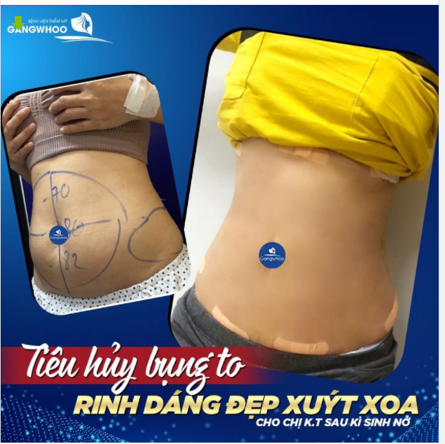TIÊU HỦY BỤNG TO - RINH DÁNG ĐẸP XUÝT XOA CHO CHỊ K.T SAU KÌ SINH NỞ