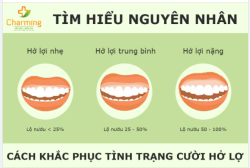 TÌM HIỂU NGUYÊN NHÂN VÀ CÁCH KHẮC PHỤC TÌNH TRẠNG CƯỜI HỞ LỢI