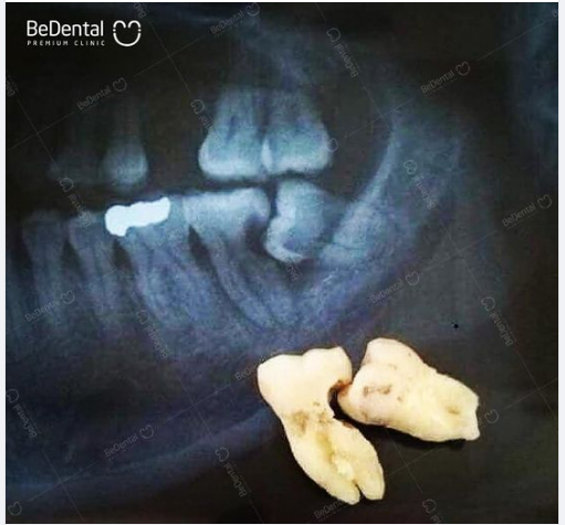 "Tình đầu như chiếc răng khôn làm mình đau...!"