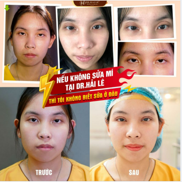 Tình trạng trước của Ngọc Linh mí mắt trợn lờ đờ; cân cơ nâng mi yếu gây liệt cơ; hốc mắt sâu; da mí nhăn nheo, sẹo xơ cứng...do từng cắt mí bị hỏng tại một cơ sở thiếu uy tín trước đó.