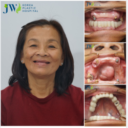 Tóc điểm sương, nương implant Nhưng không phải ai cũng thành..