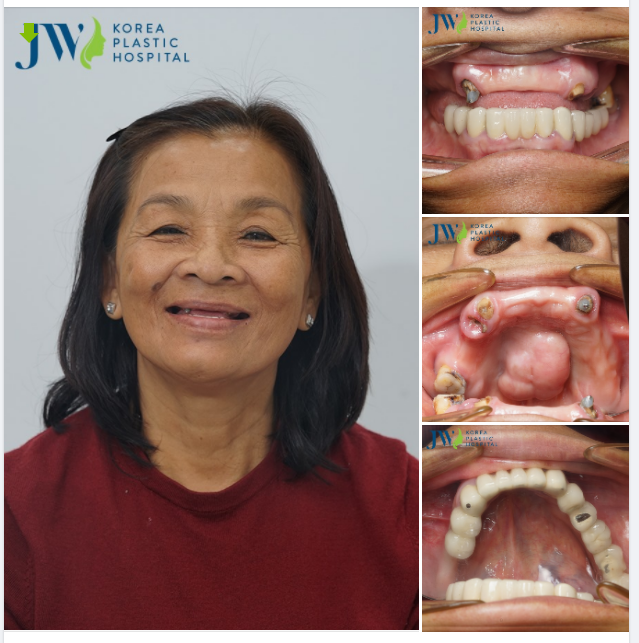 Tóc điểm sương, nương implant Nhưng không phải ai cũng thành..