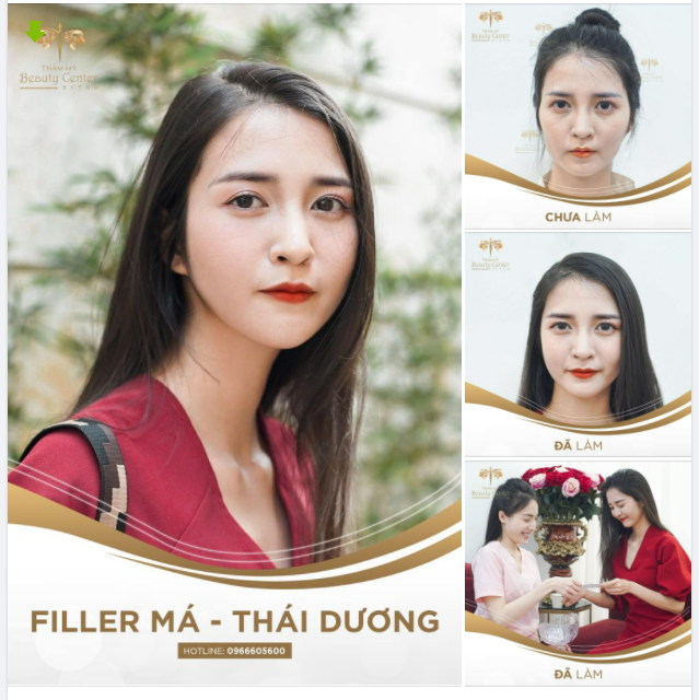 Trả lại nét xuân thì- ĐẸP TỰ NHIÊN nhưng không tự nhiên mà đẹp. Bí kíp chính là Filler đầy hóp má, thái dương tại Tấm.